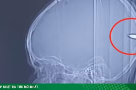 Thấy con hay buồn ngủ bố mẹ đưa đi chụp CT và phát hiện sốc