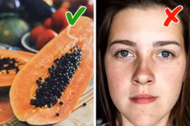 6 thực phẩm giúp ngăn ngừa sẹo do mụn trứng cá