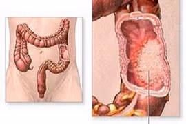 8 sự thật về ung thư có thể bạn chưa biết