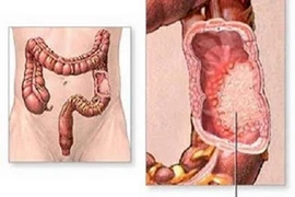 8 sự thật về ung thư có thể bạn chưa biết