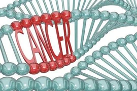 Thuốc chữa Parkinson giảm nguy cơ ung thư vú