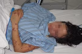 Cách ly khẩn cấp cô gái mắc viêm não mô cầu ở Hà Nội