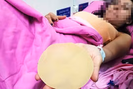 Ca sĩ Ivy Trần vỡ túi nâng ngực: Bác sĩ mổ nói gì? 