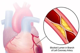 Mối liên hệ giữa bệnh mỡ máu cao và bệnh tim mạch 
