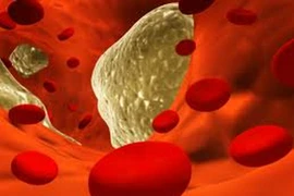 Bệnh máu nhiễm mỡ có nguy hiểm không? 