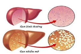 Hiểm họa đến từ gan nhiễm mỡ 