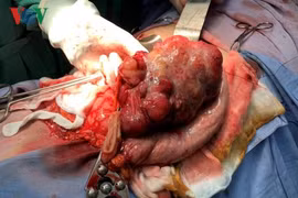 Phẫu thuật thành công cho bệnh nhân có khối u dạ dày nặng gần 2kg
