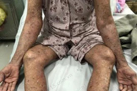 Tự ý dùng thuốc trị gout, cụ bà 83 tuổi nổi phỏng đỏ toàn thân