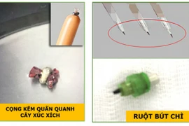 Trẻ tử vong do hóc dị vật là cọng kẽm ở đầu cây xúc xích