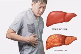 Dấu hiệu ung thư gan giai đoạn đầu dễ nhầm với bệnh lý khác