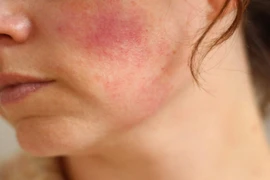Nhận biết da bị kích ứng do mỹ phẩm