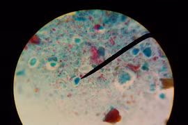 Kinh hãi 2kg sán bám đặc quanh lá gan cô gái trẻ