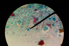 Kinh hãi 2kg sán bám đặc quanh lá gan cô gái trẻ