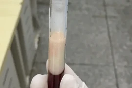 Mắc viêm tụy cấp, người đàn ông có máu đặc như sữa