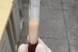 Mắc viêm tụy cấp, người đàn ông có máu đặc như sữa