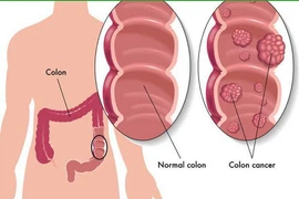 28 tuổi ung thư đại trực tràng vì thói quen nhiều người mắc