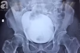 Nhịn tiểu từ Vũng Tàu về TP HCM, người đàn ông suýt chết 