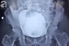 Nhịn tiểu từ Vũng Tàu về TP HCM, người đàn ông suýt chết 