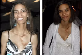 Bà mẹ có 2 tử cung vẫn sinh 2 con khỏe mạnh