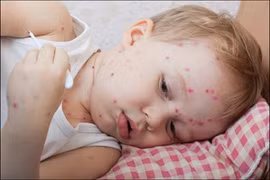 Các giai đoạn bệnh thủy đậu phát triển có thể bạn chưa biết