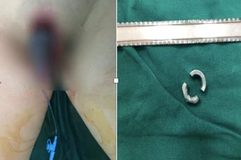 Bác sĩ cưa đai ốc, cứu “cậu nhỏ” của bệnh nhi 11 tuổi ở Sóc Trăng