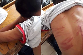 79 vết thương trên người, nam sinh lớp 8 hoảng hốt kể lại chuyện bị bố đẻ bạo hành