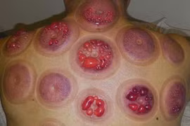 Vợ bị bỏng vì nửa đêm về sáng được chồng giác hơi