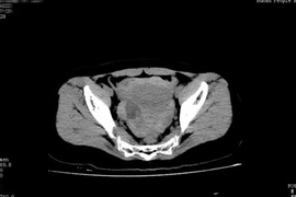 Hy hữu: Suýt chết vì vỡ u nang buồng trứng khi yêu