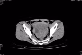 Hy hữu: Suýt chết vì vỡ u nang buồng trứng khi yêu