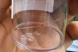 Người đàn ông nguy kịch vì nuốt xương cá từ miệng xuống tới bàng quang