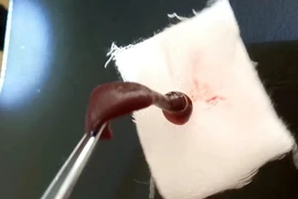 Đỉa dài 6cm sống trong mũi nam thanh niên