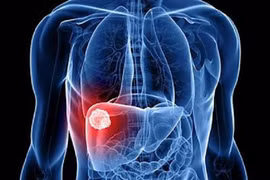 Thói quen xấu khiến người Việt phát hiện ung thư gan ở giai đoạn muộn