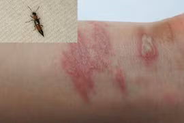 Sai lầm trong điều trị tổn thương do kiến ba khoang