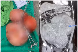 Nữ bệnh nhân 35 tuổi có khối u xơ tử cung nặng 5,5kg