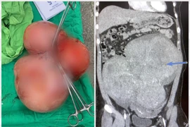 Nữ bệnh nhân 35 tuổi có khối u xơ tử cung nặng 5,5kg