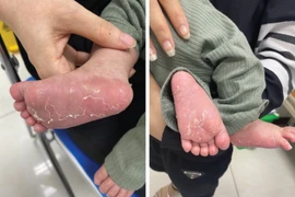 Trẻ 46 ngày tuổi bị giang mai