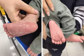 Trẻ 46 ngày tuổi bị giang mai