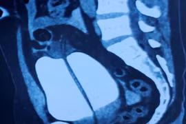 Hi hữu: Nam thanh niên nhập viện vì... vỡ bàng quang sau cuộc nhậu