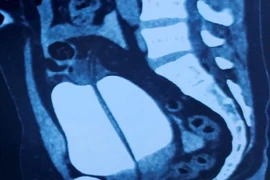 Hi hữu: Nam thanh niên nhập viện vì... vỡ bàng quang sau cuộc nhậu