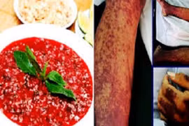 Biến chứng nguy hiểm khi nhiễm liên cầu khuẩn lợn: Phòng bệnh sao?