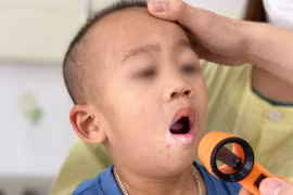 Dấu hiệu trẻ mắc tay chân miệng cần nhập viện