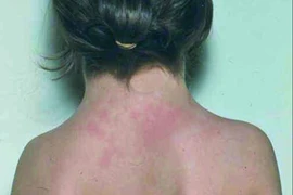 Bé gái ở Nghệ An mắc hội chứng Turner