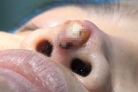 Cô gái 28 tuổi lãnh hậu quả nặng nề khi làm đẹp ở thẩm mỹ viện