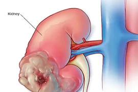 6 triệu chứng ung thư thận nhiều người bỏ qua