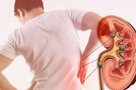 4 thói quen khiến thận lổn nhổn toàn sỏi