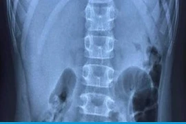 Vì sao 3 bệnh nhi ở Hải Phòng bị thủng dạ dày khi mắc COVID-19?