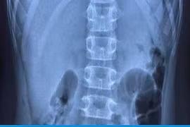 Vì sao 3 bệnh nhi ở Hải Phòng bị thủng dạ dày khi mắc COVID-19?