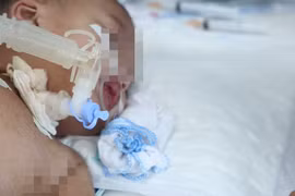 Bé 2 tuổi gặp biến chứng rất nặng sau nhiễm Adenovirus