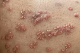 U nổi khắp người do rối loạn mỡ máu: Dễ tai biến mạch máu não