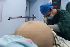 Bụng to bất thường, đi khám phát hiện khối u khổng lồ nặng 21 kg 